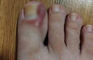 How to Treat an Ingrown Toenail at Home: Tips and Natural Remedies