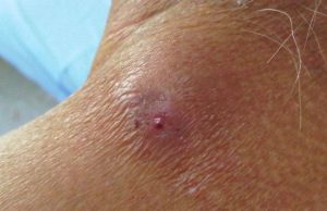 He Thought He Had Acne, But It Was Something Completely Different